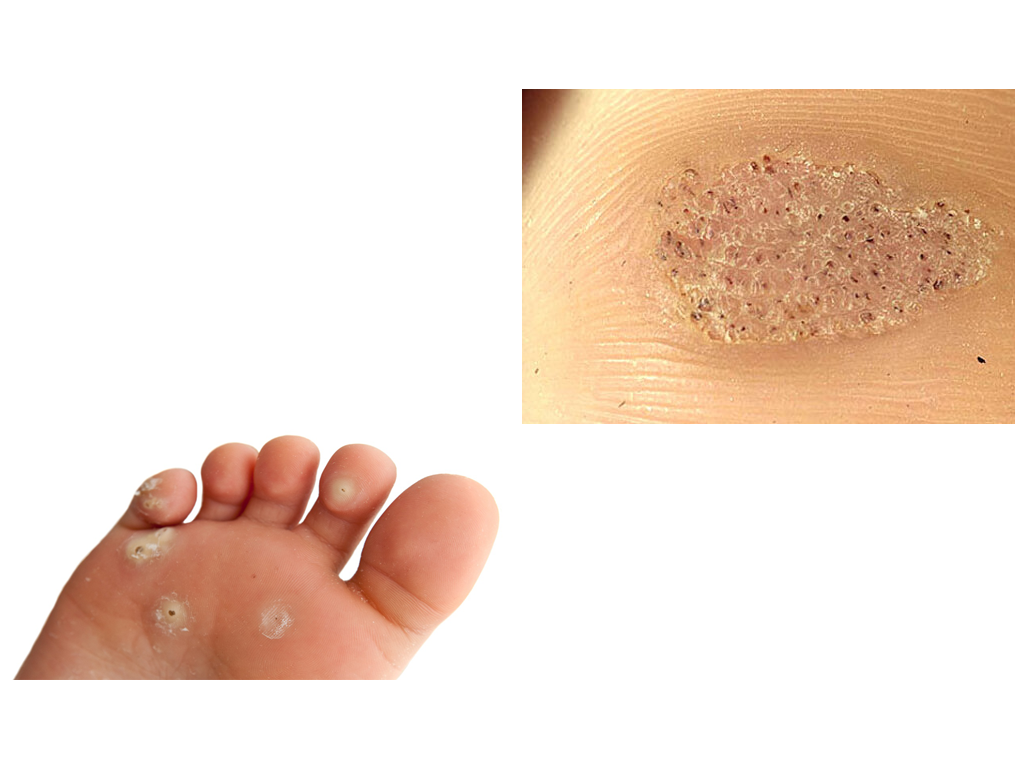 Plantar warts - Symptoms and When should I seek medical attention?