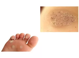 Plantar warts - Symptoms and When should I seek medical attention?