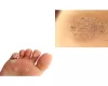 Plantar warts - Symptoms and When should I seek medical attention?